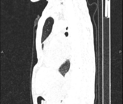 Air bronchogram in pneumonia (Radiopaedia 85719-101512 Sagittal lung window 51).jpg