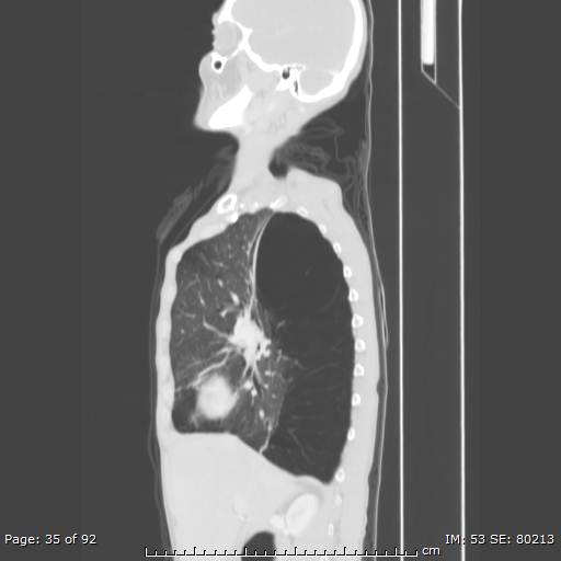File:Alpha-1-antitrypsin deficiency (Radiopaedia 50561-55987 Sagittal lung window 17).jpg