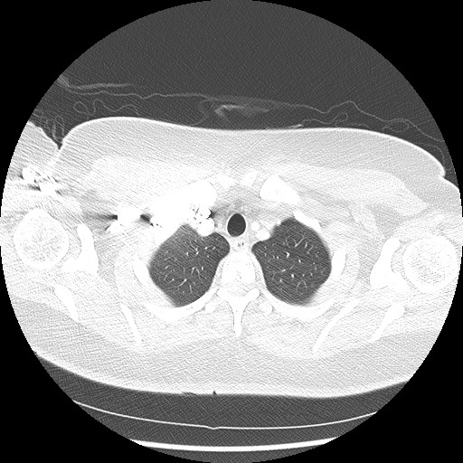 Alveolar soft part sarcoma - right leg (Radiopaedia 59432-67091 Axial lung window 16).jpg