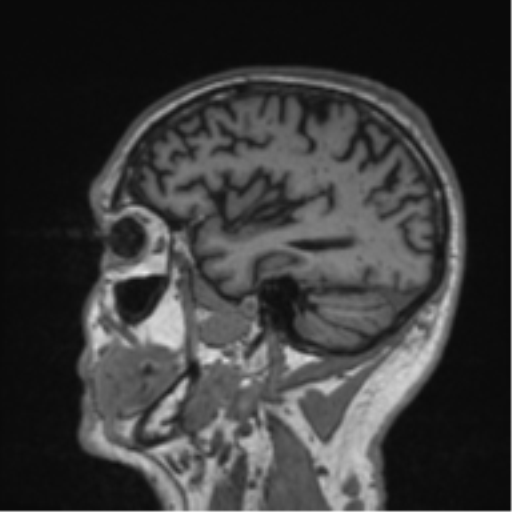 Alzheimer's disease- with Gerstmann syndrome and dressing apraxia (Radiopaedia 54882-61150 Sagittal T1 15).png
