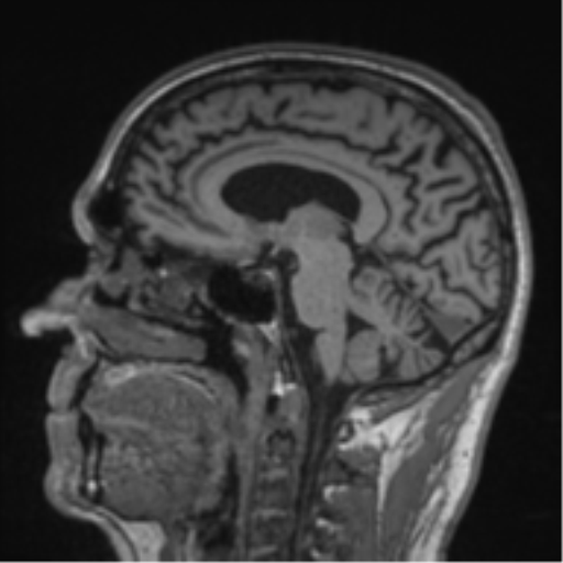 Alzheimer's disease- with Gerstmann syndrome and dressing apraxia (Radiopaedia 54882-61150 Sagittal T1 39).png