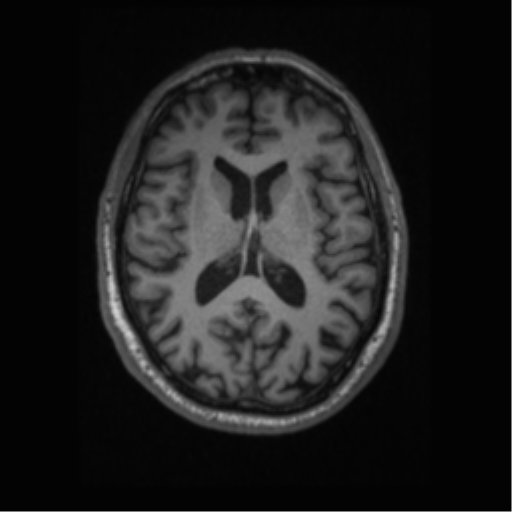 Alzheimer disease - probable (Radiopaedia 35334-36837 Axial T1 44).png