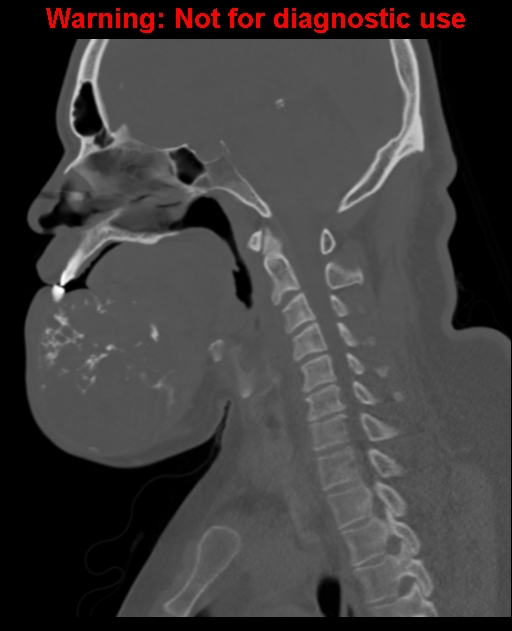 Ameloblastoma (Radiopaedia 33126-34164 Sagittal bone window 39).jpg