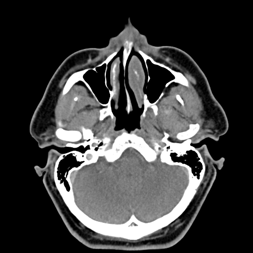Ameloblastoma (Radiopaedia 38520-40623 Axial non-contrast 15).png