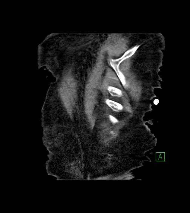 Amiodarone deposition in the liver (Radiopaedia 77587-89780 Coronal non-contrast 74).jpg