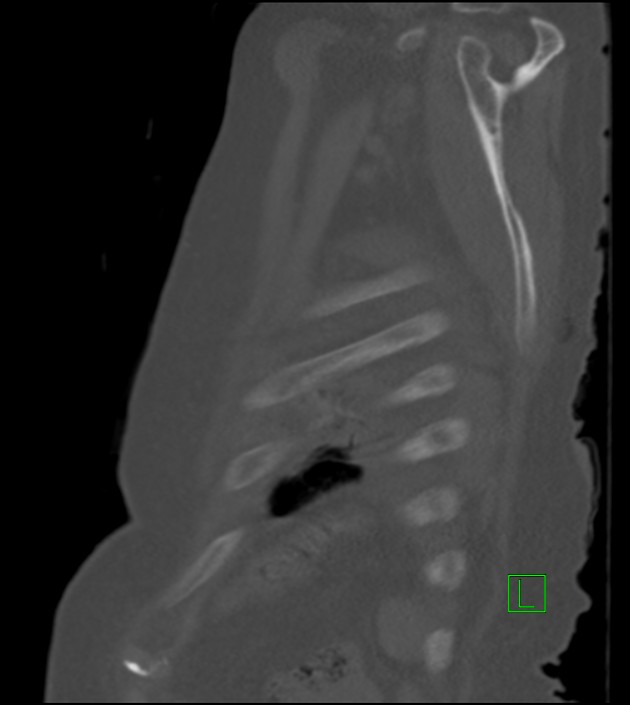 Amiodarone deposition in the liver (Radiopaedia 77587-89780 Sagittal bone window 17).jpg