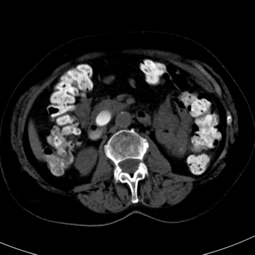 File:Ampullary adenocarcinoma (Radiopaedia 34013-35241 AXIAL THICK 45).png