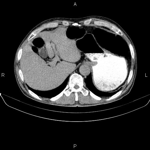Ampullary adenocarcinoma (Radiopaedia 86093-102032 Axial C+ delayed 17).jpg