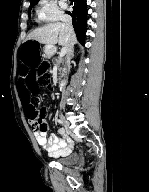 Ampullary adenocarcinoma (Radiopaedia 86093-102032 D 40).jpg