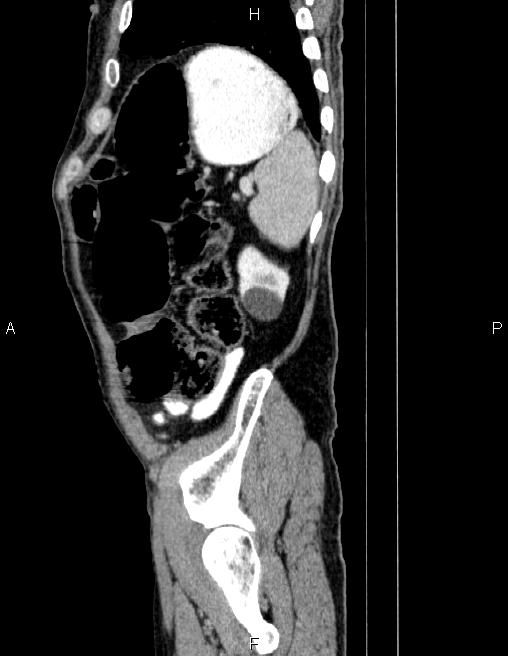 Ampullary adenocarcinoma (Radiopaedia 86093-102032 D 82).jpg