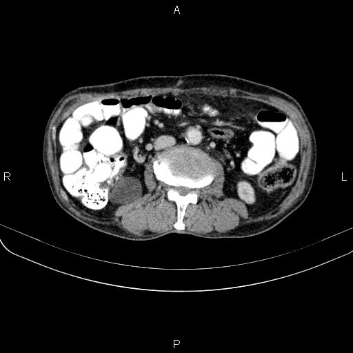 Ampullary adenocarcinoma (Radiopaedia 86093-102033 B 72).jpg