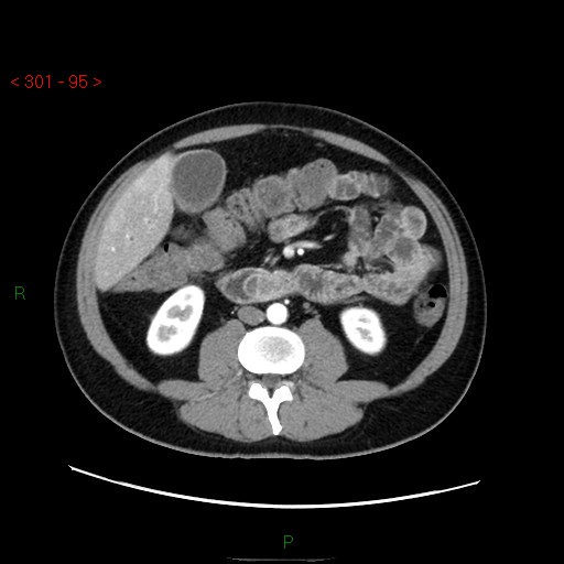 Ampullary carcinoma (Radiopaedia 56396-63056 B 41).jpg