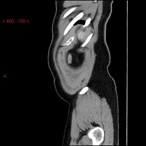 Ampullary carcinoma (Radiopaedia 56396-63056 D 99).jpg