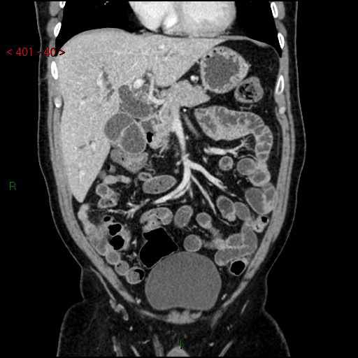 Ampullary carcinoma (Radiopaedia 56396-63056 E 39).jpg