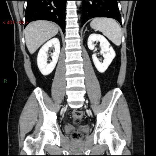 Ampullary carcinoma (Radiopaedia 56396-63056 E 65).jpg