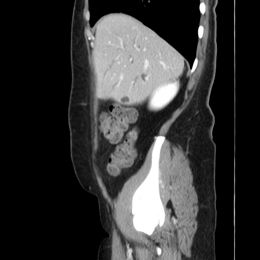 Ampullary tumor (Radiopaedia 22787-22816 D 13).jpg