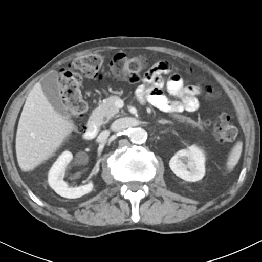File:Amyand hernia (Radiopaedia 39300-41547 A 23).png