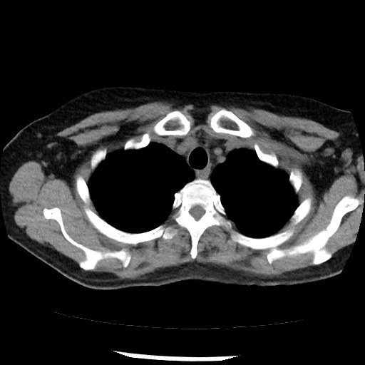 Amyloidosis - bronchial and diffuse nodular pulmonary involvement (Radiopaedia 60156-67744 Axial non-contrast 10).jpg