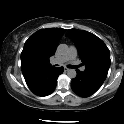 Amyloidosis - bronchial and diffuse nodular pulmonary involvement (Radiopaedia 60156-67744 Axial non-contrast 26).jpg