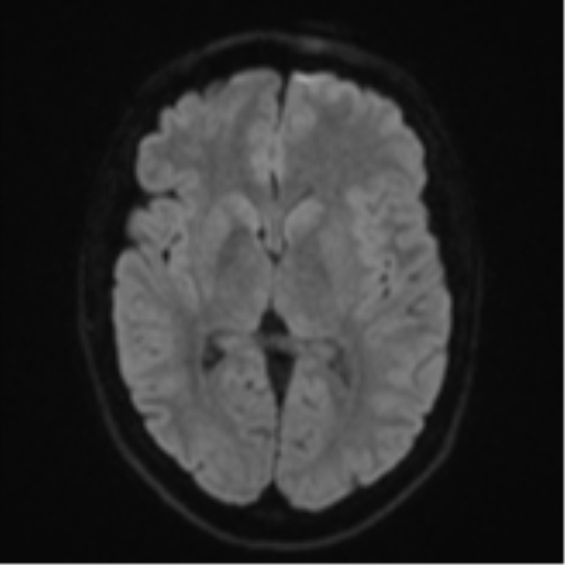Anaplastic astrocytoma (Radiopaedia 57768-64731 Axial DWI 42).png