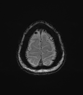 Anaplastic astrocytoma (Radiopaedia 86943-103160 Axial SWI 81).png