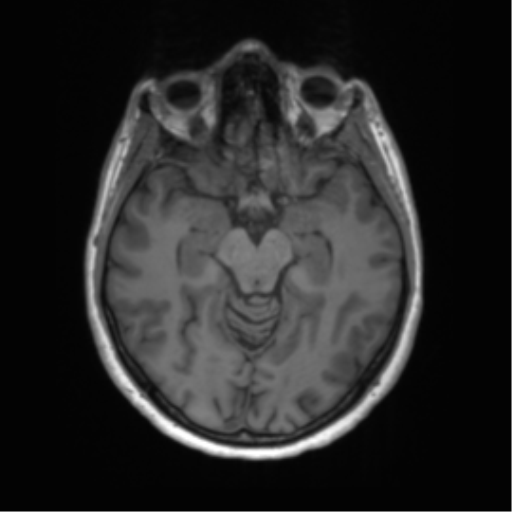 File:Anaplastic astrocytoma - thalamic glioma (Radiopaedia 59709-67115 Axial T1 7).png