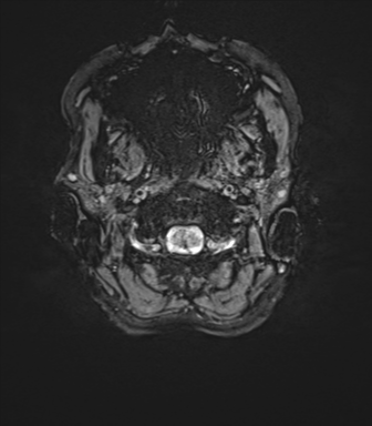 File:Anaplastic astrocytoma IDH mutant (Radiopaedia 50046-55341 Axial SWI 2).png