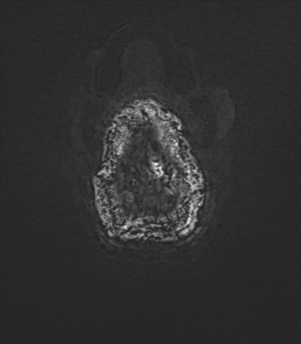 Anaplastic astrocytoma IDH mutant (Radiopaedia 50046-55341 Axial SWI 87).png