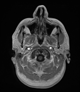 File:Anaplastic astrocytoma IDH wild-type (Radiopaedia 49984-55273 Axial T1 C+ 6).png