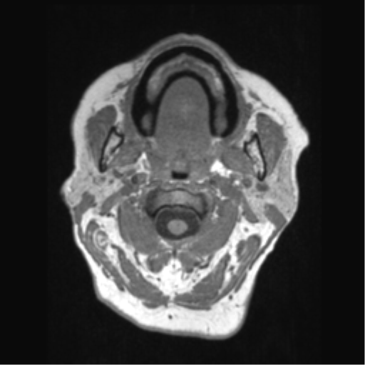 Anaplastic astrocytoma IDH wild-type (pseudoprogression) (Radiopaedia 42209-45276 Axial T1 2).png