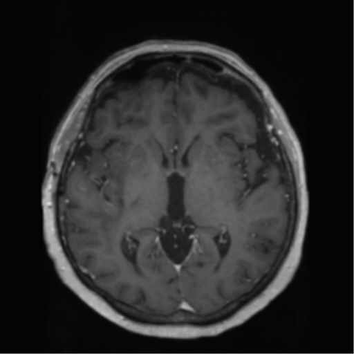 File:Anaplastic astrocytoma IDH wild-type (pseudoprogression) (Radiopaedia 42209-45278 Axial T1 C+ 80).png