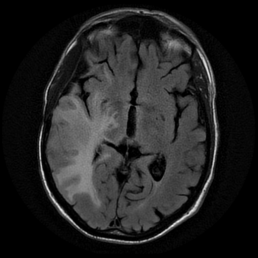 File:Anaplastic meningioma with recurrence (Radiopaedia 34452-35790 Axial T2 FLAIR 10).png