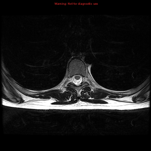 File:Aneurysmal bone cyst (Radiopaedia 9419-10103 Axial T2 1).jpg