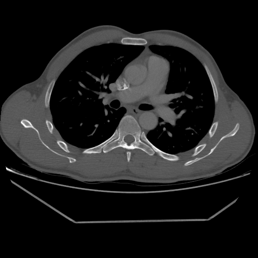 File:Aneurysmal bone cyst - rib (Radiopaedia 82167-96220 Axial bone window 123).jpg