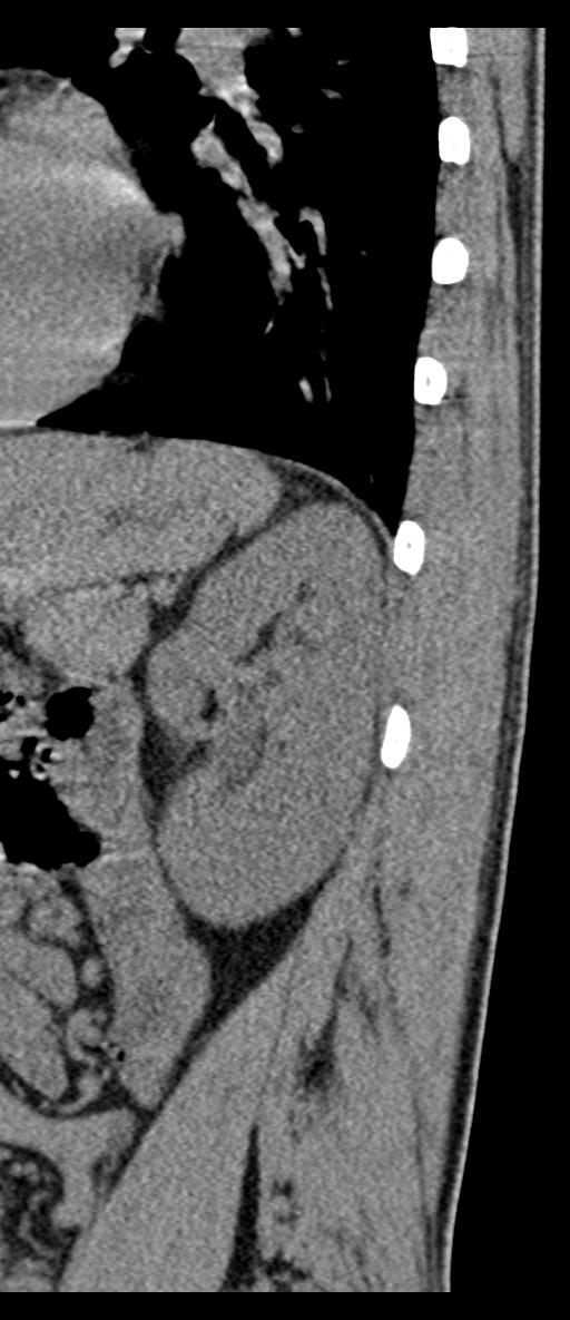 Aneurysmal bone cyst T11 (Radiopaedia 29294-29721 E 4).jpg