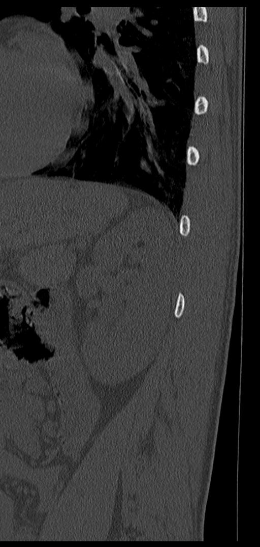Aneurysmal bone cyst T11 (Radiopaedia 29294-29721 Sagittal bone window 4).jpg