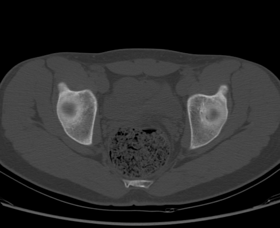 File:Aneurysmal bone cyst of ischium (Radiopaedia 25957-26094 Axial bone window 50).png