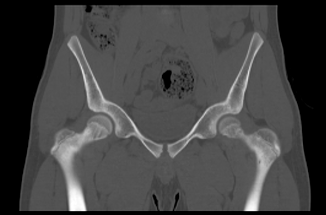 File:Aneurysmal bone cyst of ischium (Radiopaedia 25957-26094 Coronal bone window 14).png