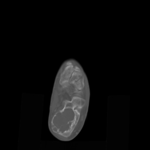 File:Aneurysmal bone cyst of the calcaneus (Radiopaedia 60669-68421 Axial bone window 8).jpg