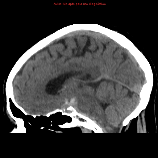 File:Aneurysmal subarachnoid hemorrhage (Radiopaedia 24740-24997 non-contrast 28).jpg