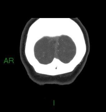 File:Aneurysmal subarachnoid hemorrhage with intra-axial extension (Radiopaedia 84371-99732 C 10).jpg