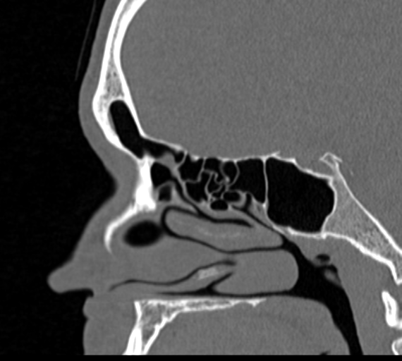 Angular epidermoid cyst (Radiopaedia 46908-51439 Sagittal bone window 35).png