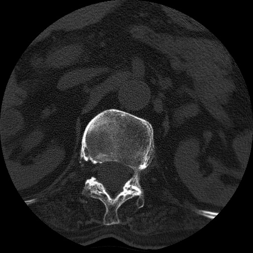 Ankylosing spondylitis complicated by fracture-dislocation (Radiopaedia 33583-34674 Axial non-contrast 7).jpg