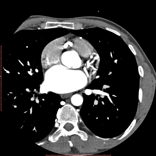File:Anomalous left coronary artery from the pulmonary artery (ALCAPA) (Radiopaedia 70148-80181 A 126).jpg