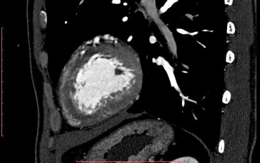 Anomalous left coronary artery from the pulmonary artery (ALCAPA) (Radiopaedia 70148-80181 C 197).jpg