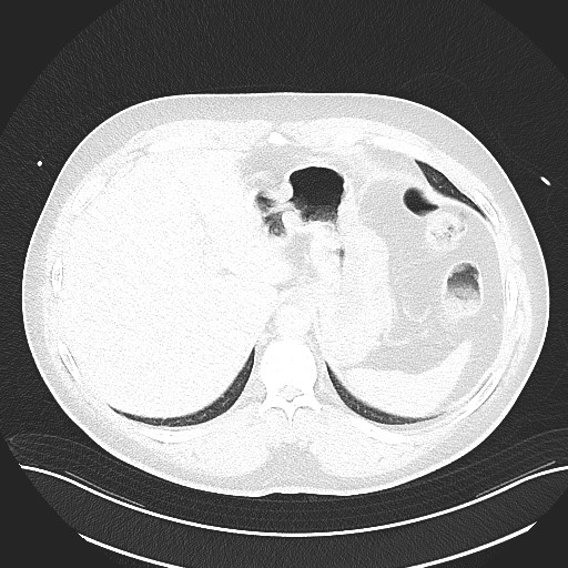 File:Anomalous origin of the left coronary artery with malignant course (Radiopaedia 77842-90126 Axial lung window 31).jpeg