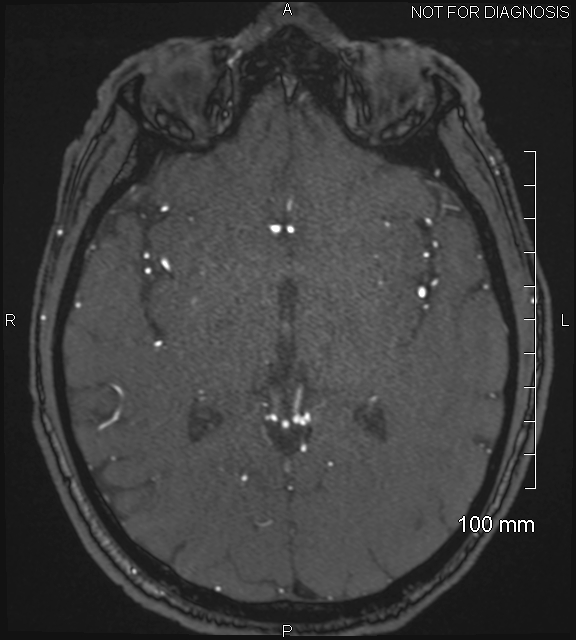 Anterior cerebral artery aneurysm (Radiopaedia 80683-94127 Axial MRA 121).jpg
