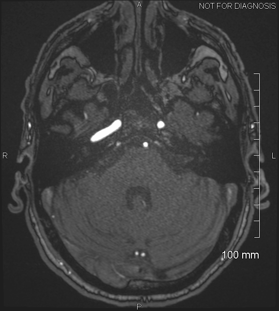Anterior cerebral artery aneurysm (Radiopaedia 80683-94127 Axial MRA 55).jpg