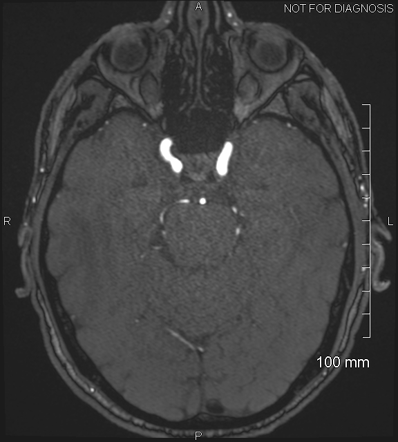 Anterior cerebral artery aneurysm (Radiopaedia 80683-94127 Axial MRA 81).jpg