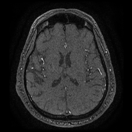 Anterior cerebral artery infarction (Radiopaedia 46794-51323 Axial MRA 127).jpg